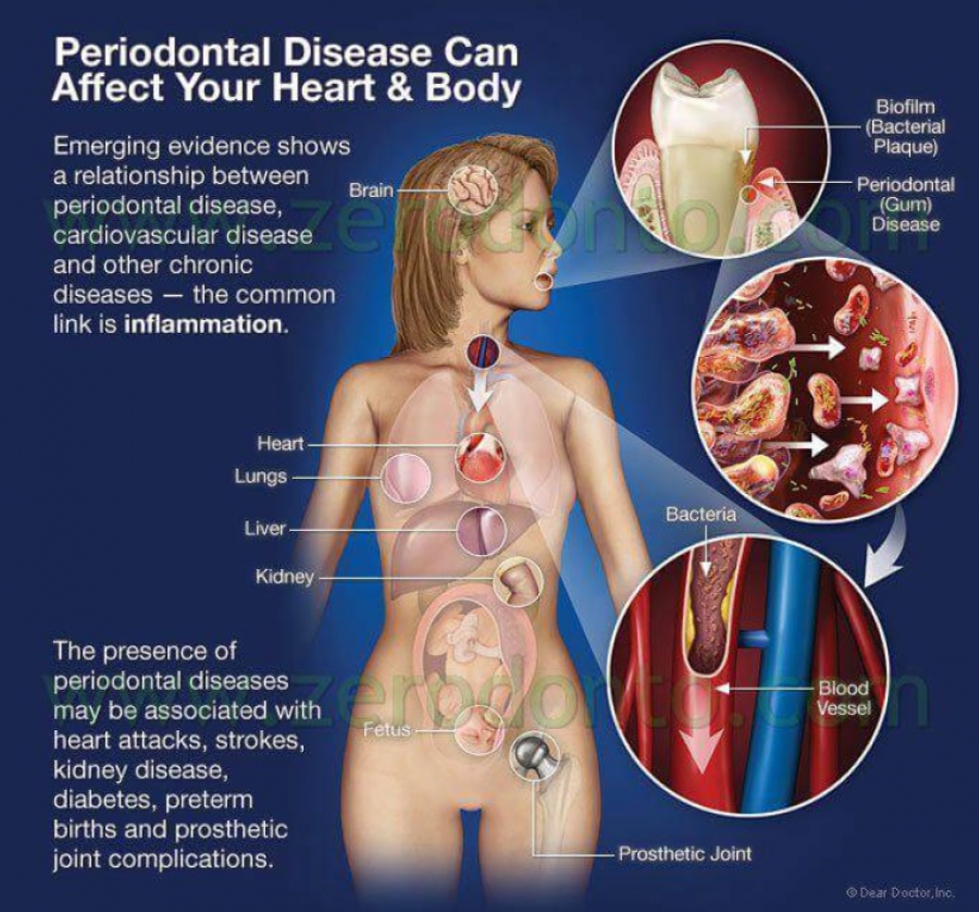 Malattia Parodontale e Cardiovascolare